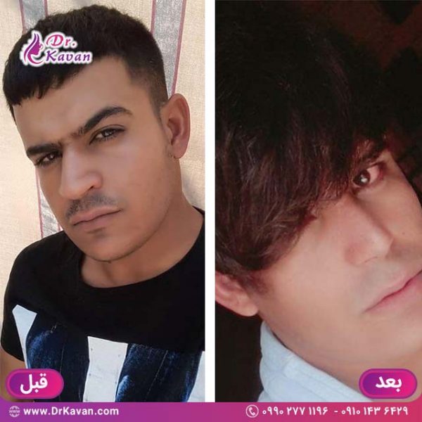 عمل زیبایی بینی