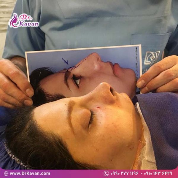 عمل زیبایی بینی