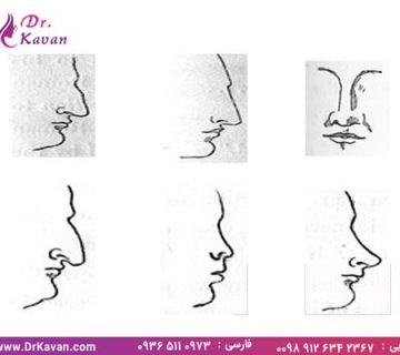 انواع بینی و انواع جراحی بینی