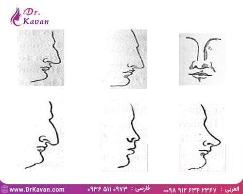 انواع بینی و انواع جراحی بینی