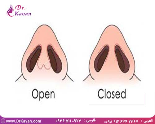 انواع بینی و انواع جراحی بینی
