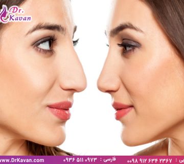 جراحی بینی استخوانی