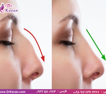 جراحی بینی چگونه انجام می شود؟