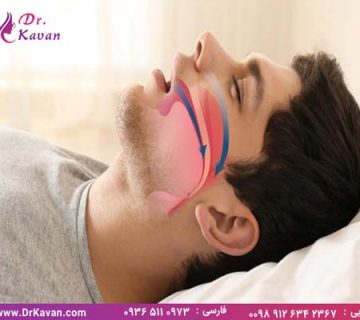 درمان خروپف