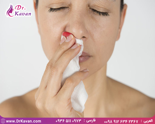 درمان خونریزی بینی
