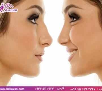 سوالات متداول در مورد عمل بینی