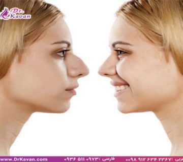 عمل بینی طبیعی