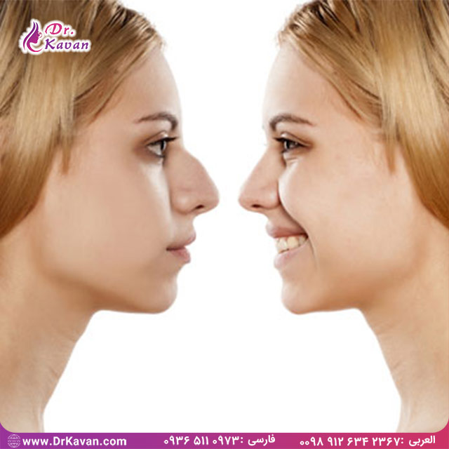 عمل بینی طبیعی