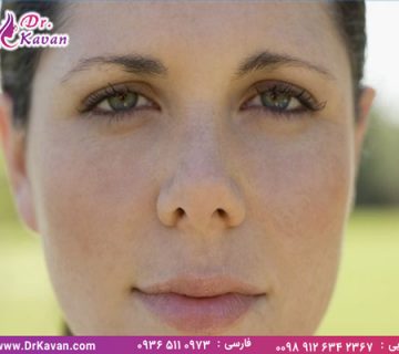 عمل بینی گوشتی