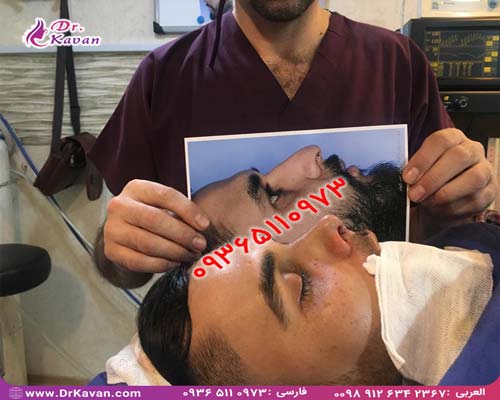 عمل بینی یا رینوپلاستی چیست