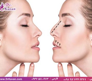 عمل بینی یا رینوپلاستی چیست