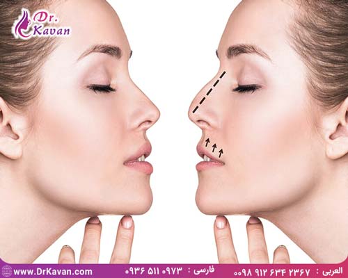 عمل بینی یا رینوپلاستی چیست