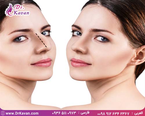 هزینه جراحی بینی