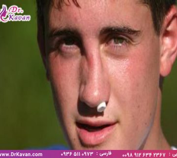 هزینه عمل بینی شکسته