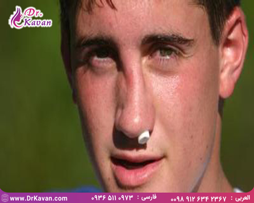 هزینه عمل بینی شکسته