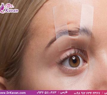 چه افرادی به عمل بلفاروپلاستی نیاز دارند